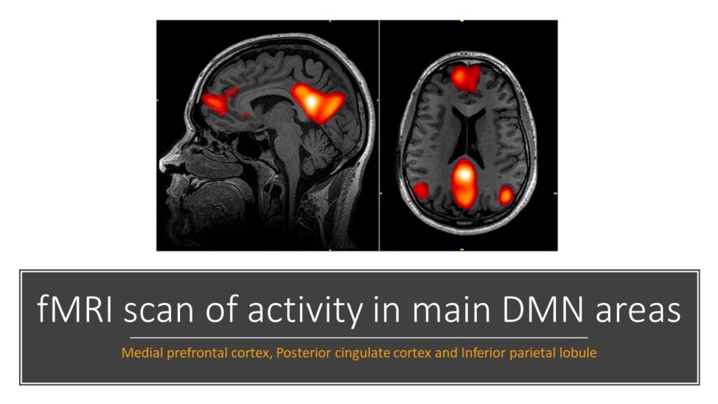 Meditation - fMRI scan of non attentional cognitive processes activity in main default mode network brain areas